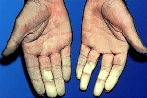 white feet|Raynauds disease: Treatment, causes,。